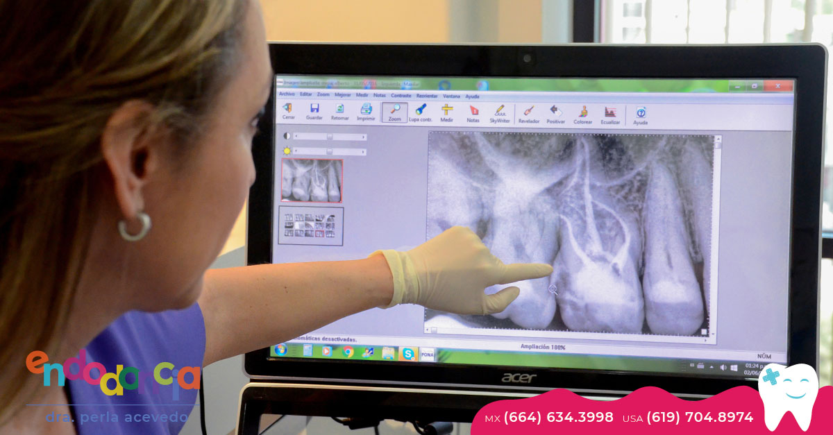 radiografia molar tijuana dentist